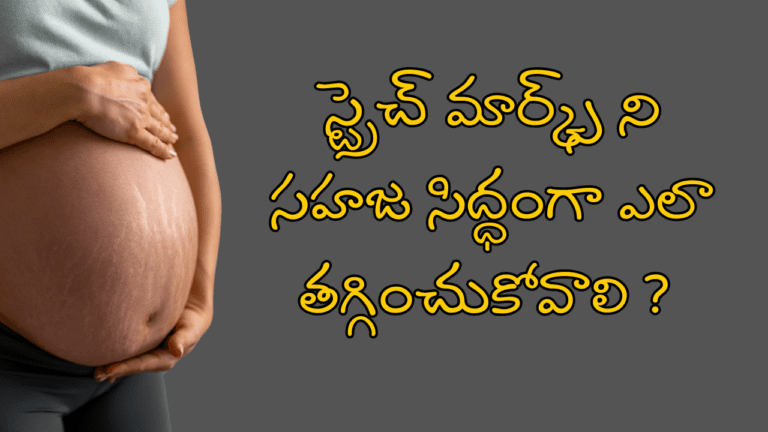 Get rid Stretch Marks Naturally Home Remedies